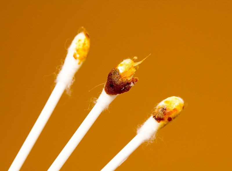 Các dấu hiệu bất thường của ráy tai có thể tiết lộ các vấn đề sức khỏe tiềm ẩn