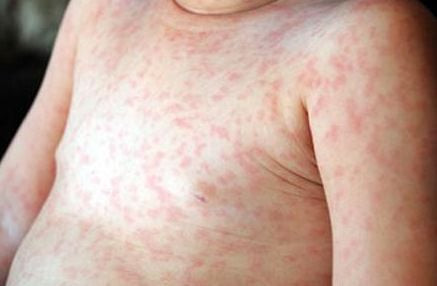 Chườm lạnh là cách giảm sưng hiệu quả sau khi trẻ sơ sinh bị va chạm ở đầu