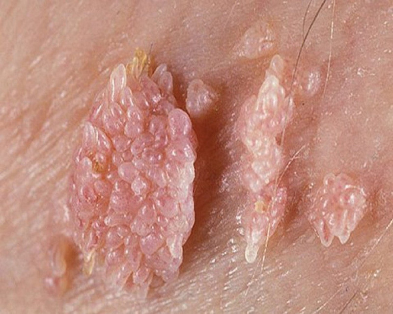 Hình ảnh minh họa các tổn thương da liên quan đến bệnh lý lây truyền, nhấn mạnh sự khác biệt giữa các loại mụn.