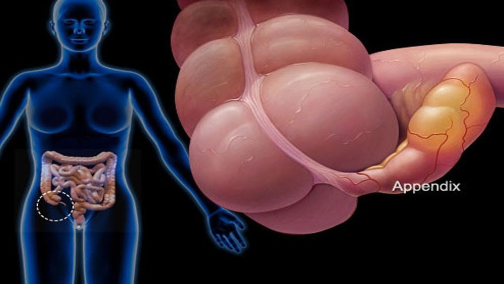 Hình ảnh minh họa vị trí ruột thừa bị viêm gây đau vùng hạ vị.