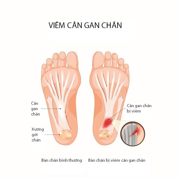 Cấu trúc cân gan bàn chân khỏe mạnh và bị viêm