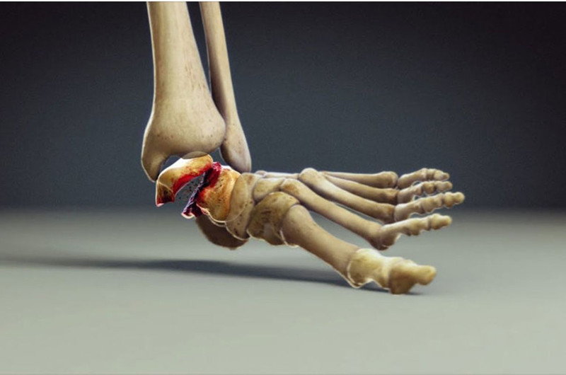Hình ảnh minh họa vị trí và cấu trúc phức tạp của khớp mắt cá chân, bộ phận quan trọng nối cẳng chân với bàn chân.