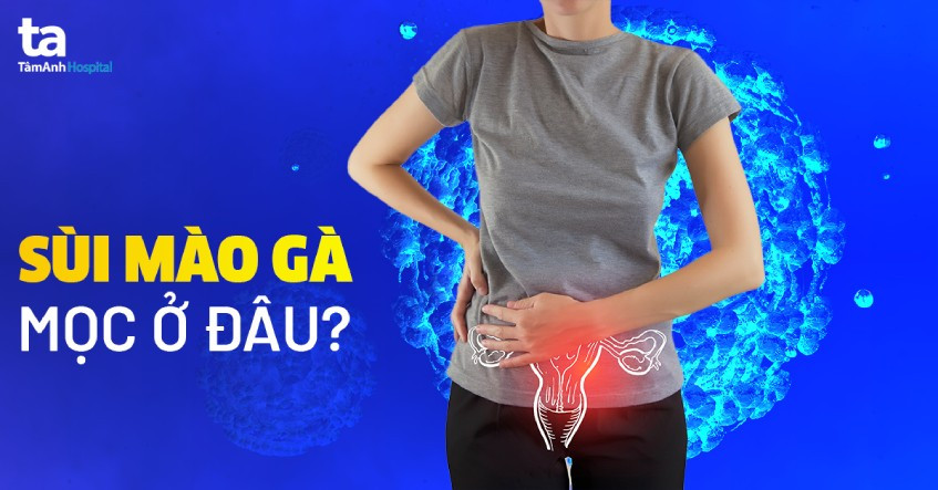 Tổn thương sùi mào gà trên da, minh họa các vị trí phổ biến của bệnh