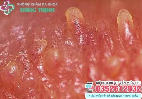 Gai sinh dục là gì?