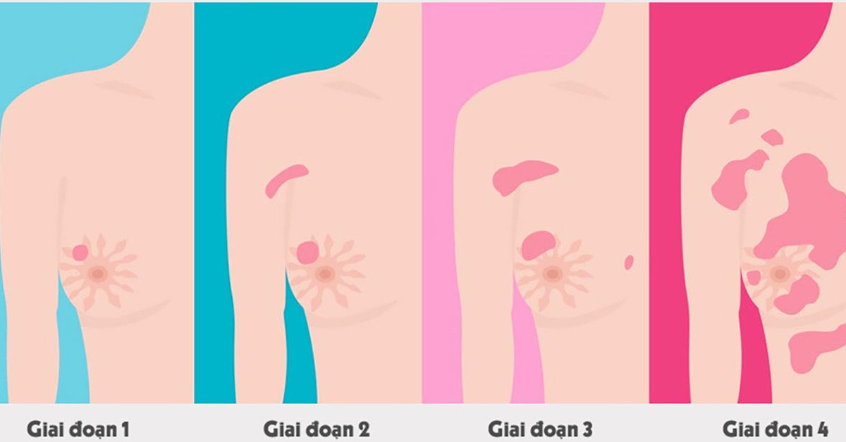 Hình ảnh minh họa các giai đoạn của bệnh ung thư vú