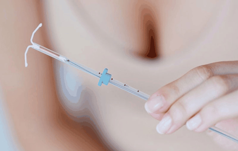 Hình ảnh mô tả vị trí đặt vòng tránh thai trong tử cung, minh họa dụng cụ tử cung giúp phòng ngừa thai hiệu quả.