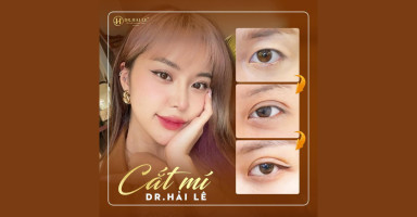 Khách hàng thực hiện cắt mí mắt đẹp tại Dr. Hải Lê