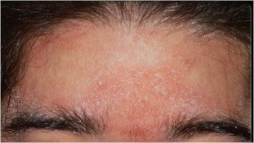 Người đang gội đầu bằng dầu gội đặc trị chống nấm giúp điều trị viêm da tiết bã ở đầu