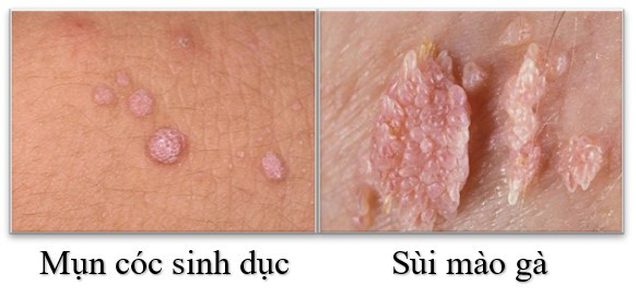 Sự khác biệt của mụn cóc sinh dục và sùi mào gà