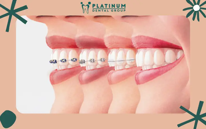 Niềng Răng Có Tác Dụng Gì? Phân Tích Toàn Diện Về Lợi Ích Thực Tế